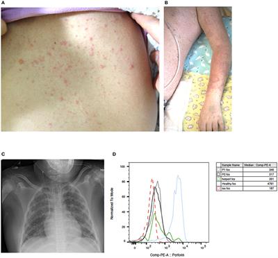 Life-Threatening Primary Varicella Zoster Virus Infection With Hemophagocytic Lymphohistiocytosis-Like Disease in GATA2 Haploinsufficiency Accompanied by Expansion of Double Negative T-Lymphocytes